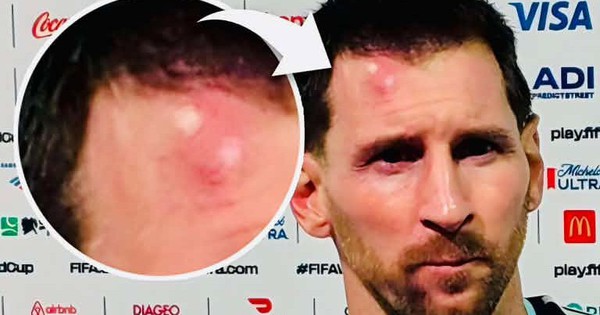 Messi sưng vêu trán sau trận thắng Cabo Verde: Vì sao nên nỗi? - hình ảnh - playabc8.com Messi sưng vêu trán sau trận thắng Cabo Verde: Vì sao nên nỗi? - hình ảnh - playabc8.com